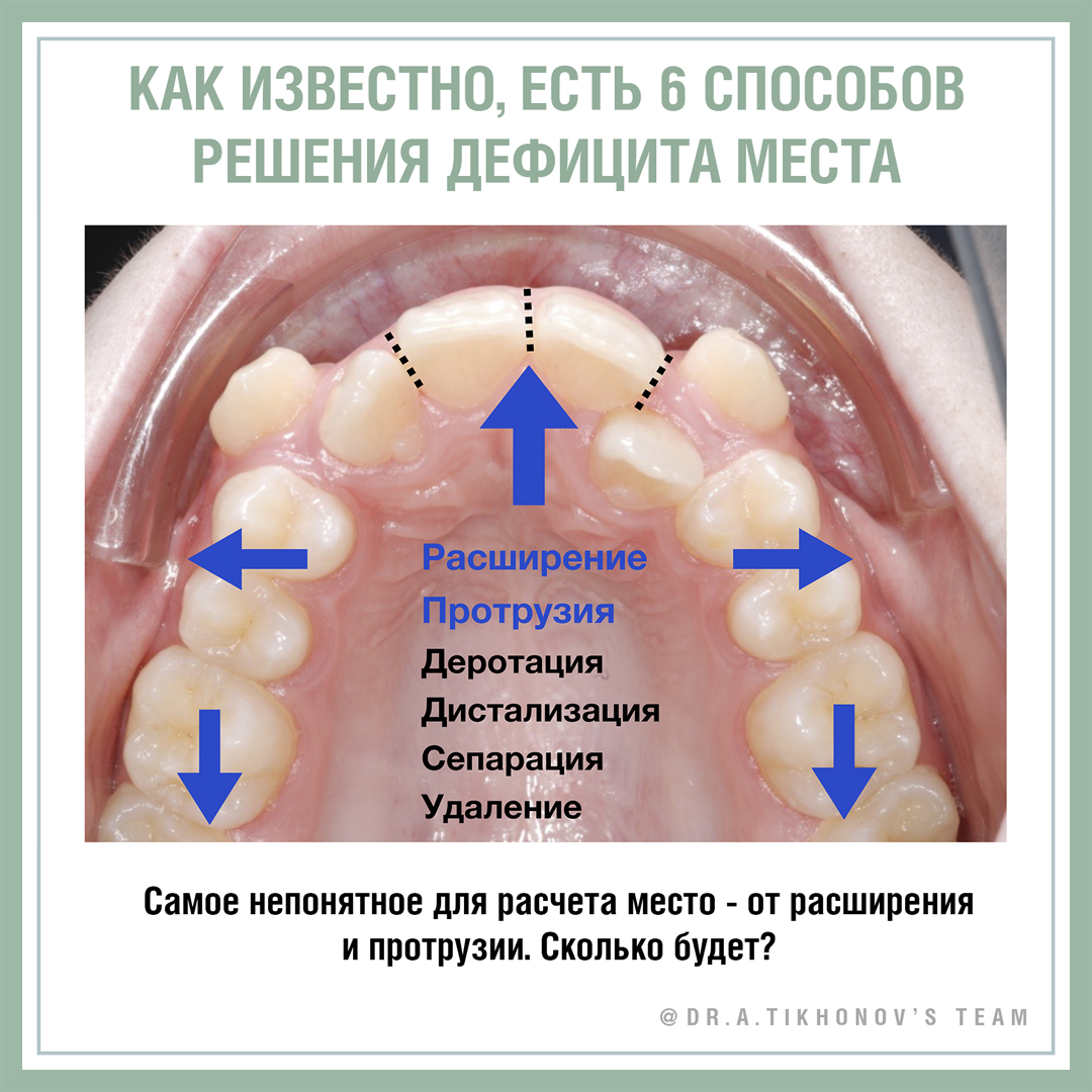 Главные задачи ортодонтии: дефицит места. - интересно об ортодонтии,  имплантации и протезировании зубов